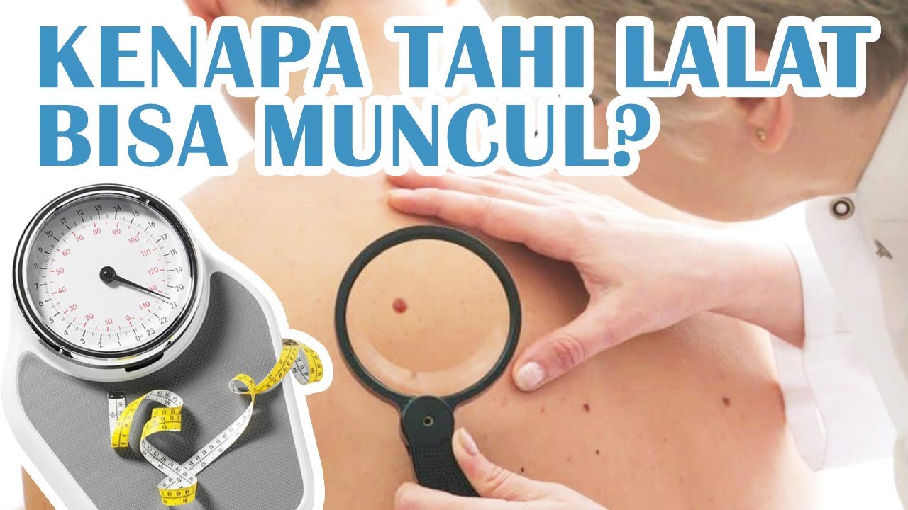 Penyebab Tahi Lalat Bisa Muncul