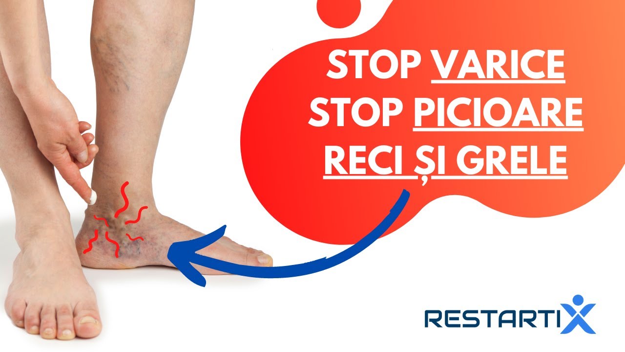 🛑 STOP VARICE ❗️ STOP PICIOARE RECI ȘI GRELE ❗️ #DuoRestartiX: Sistemul dezvoltat de ALEXANDRU ILIE