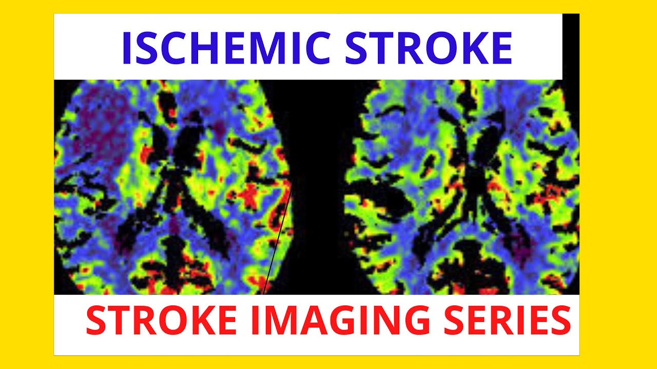 Role of CT Ischemic Stroke [Stroke Imaging Series - Lecture 1] #IschemicStroke #StrokeImaging