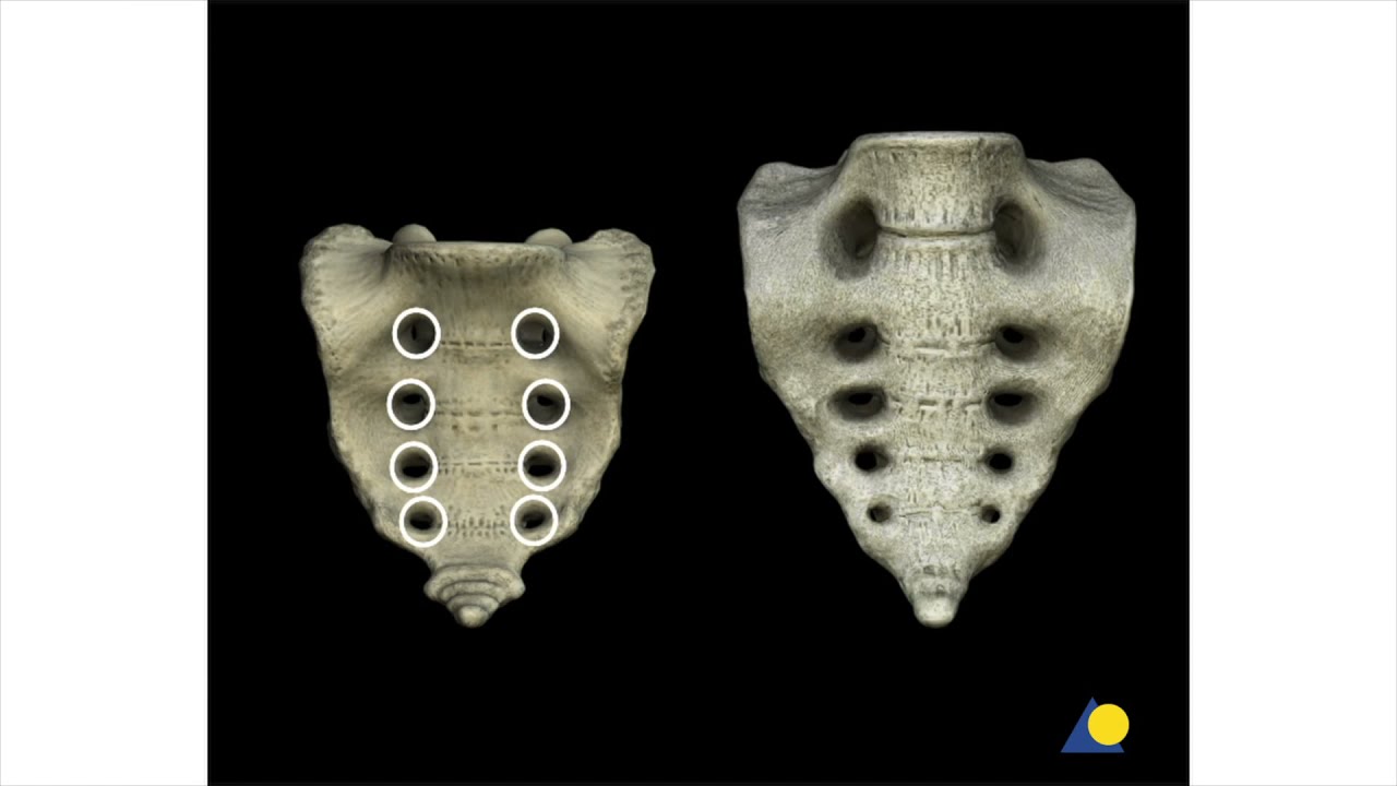 Pelvis - Sacral Fracture - Reduction and Fixation with Iliosacral Screws