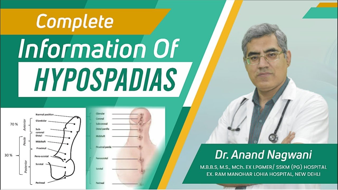 Complete Information about Hypospadias in Kolkata Hindi | वयस्क अधोमूत्रमार्गता  | Dr. Nagwani