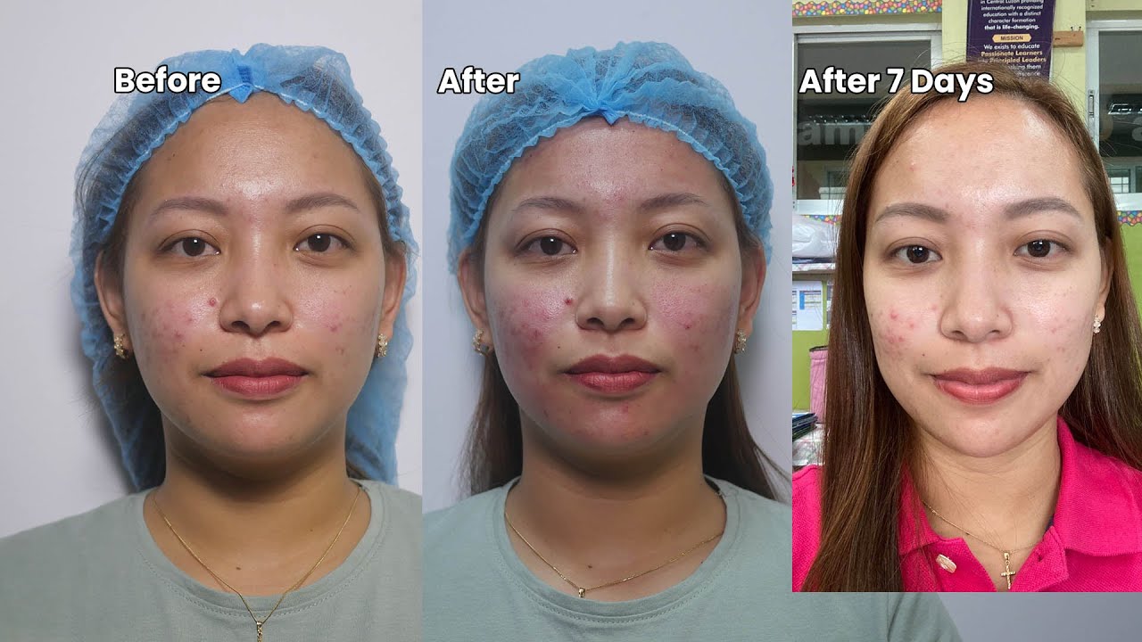 The ultimate skin solution : Genius RF microneedling
