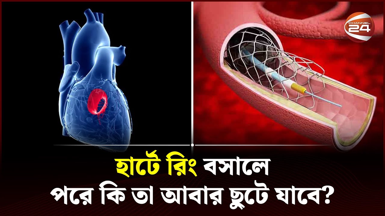 একবার হার্টে রিং বসালে পরে কি সমস্যা হতে পারে? | Heart Ring Surgery | Channel 24