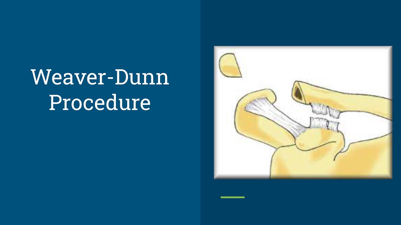 Key Step in the Weaver-Dunn Procedure | FRCS (Tr & Orth) & EBOT Part A Prep