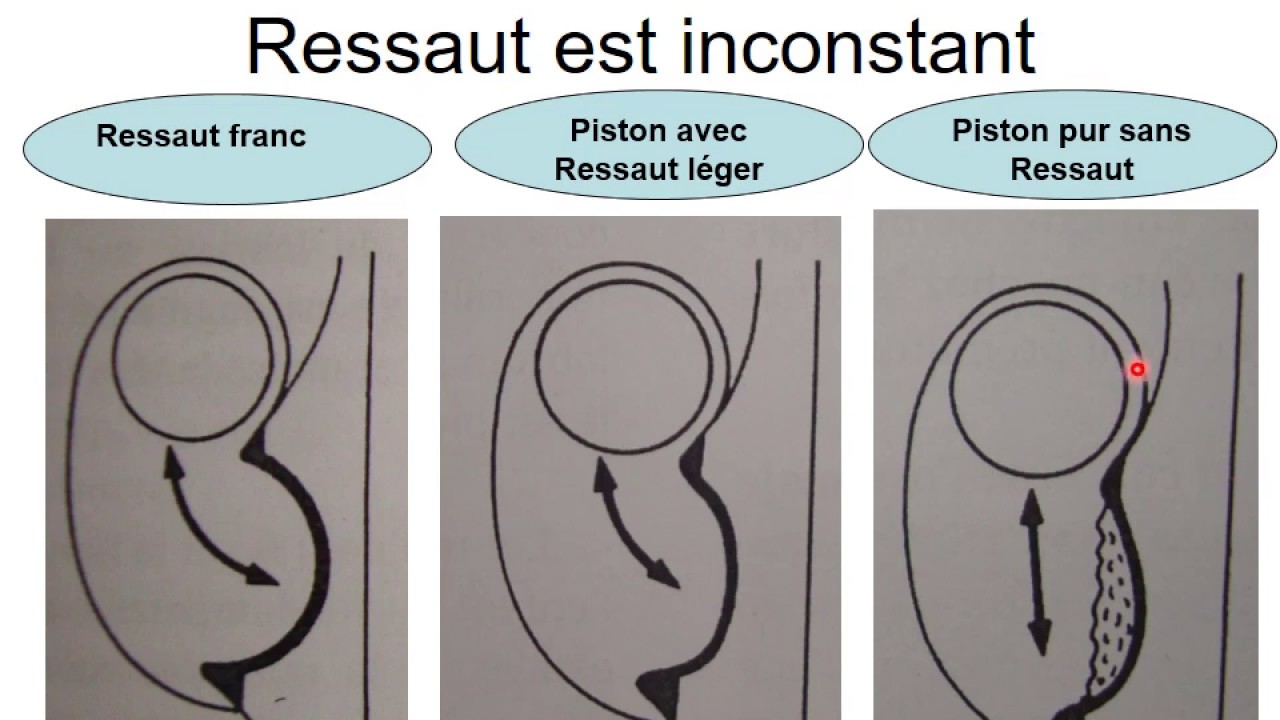 FMPM MOOCs - La maladie luxante chez l'enfant - Pr El Fezzazi