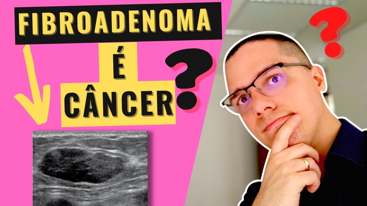 FIBROADENOMA NA MAMA (dói?): Saiba o que é, a CLASSIFICAÇÃO e a relação deste nódulo com CÂNCER!