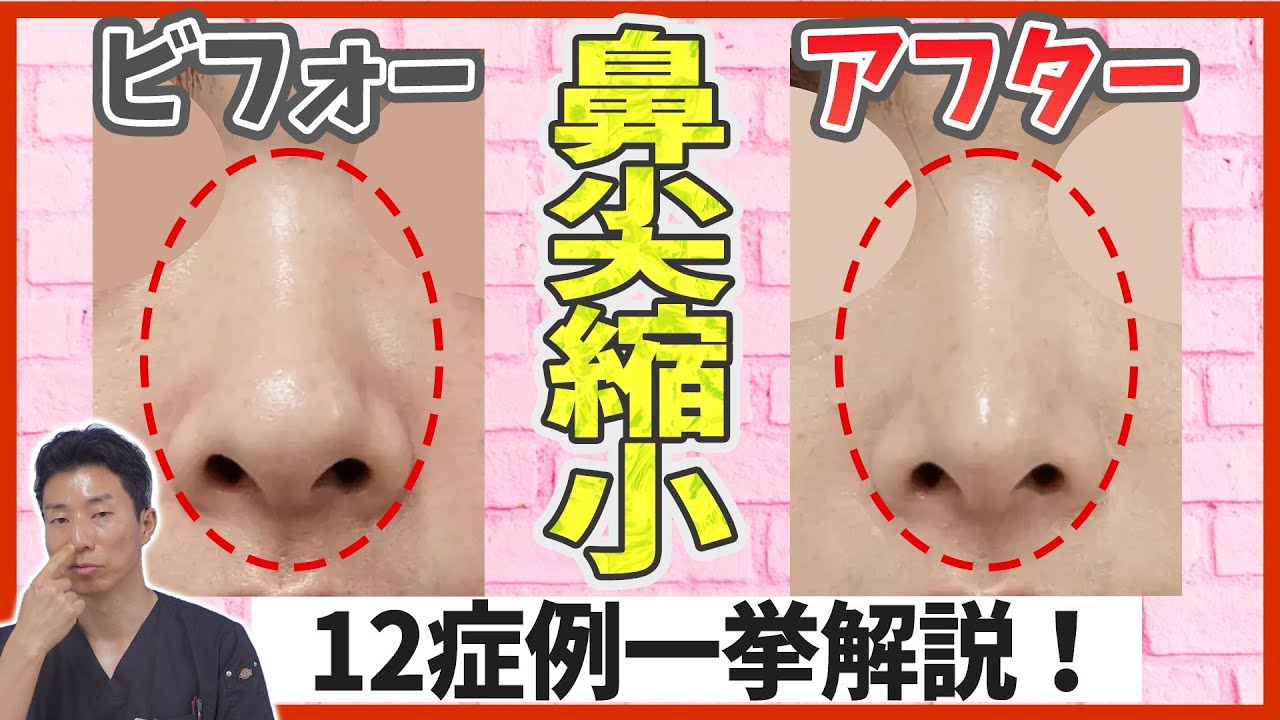【鼻整形】鼻尖縮小（団子鼻修正）の通常の施術法と3D法の症例写真を12症例ご紹介