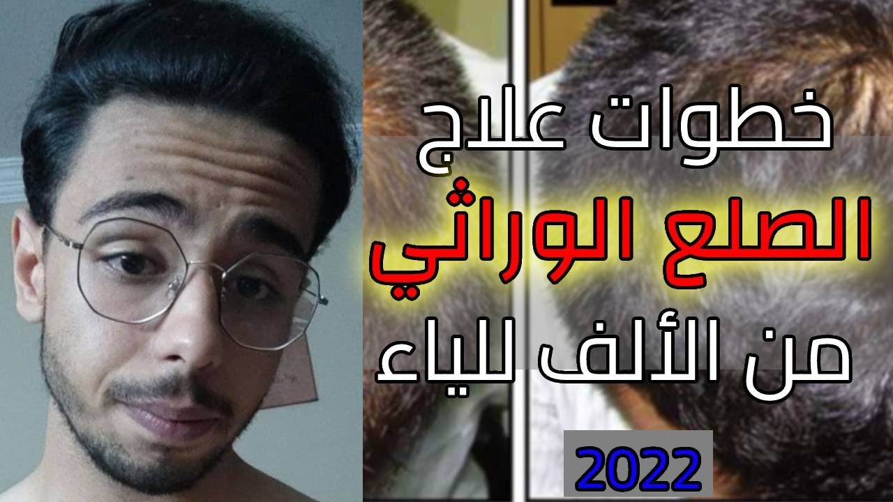 خلاصة علاج الصلع الوراثي