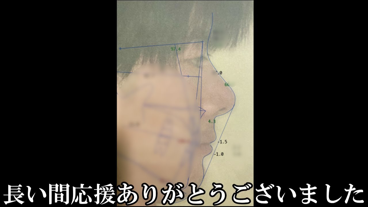 【失敗】歯列矯正その後について