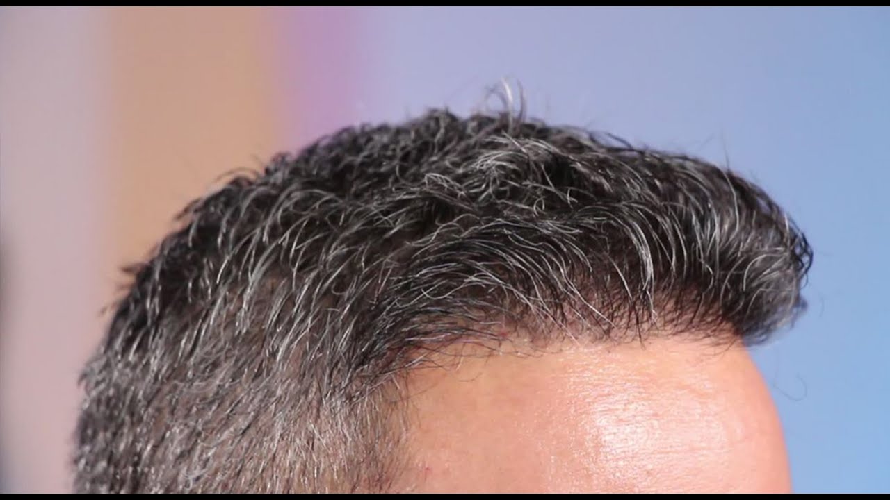 No-shave FUE Transplant - before and after