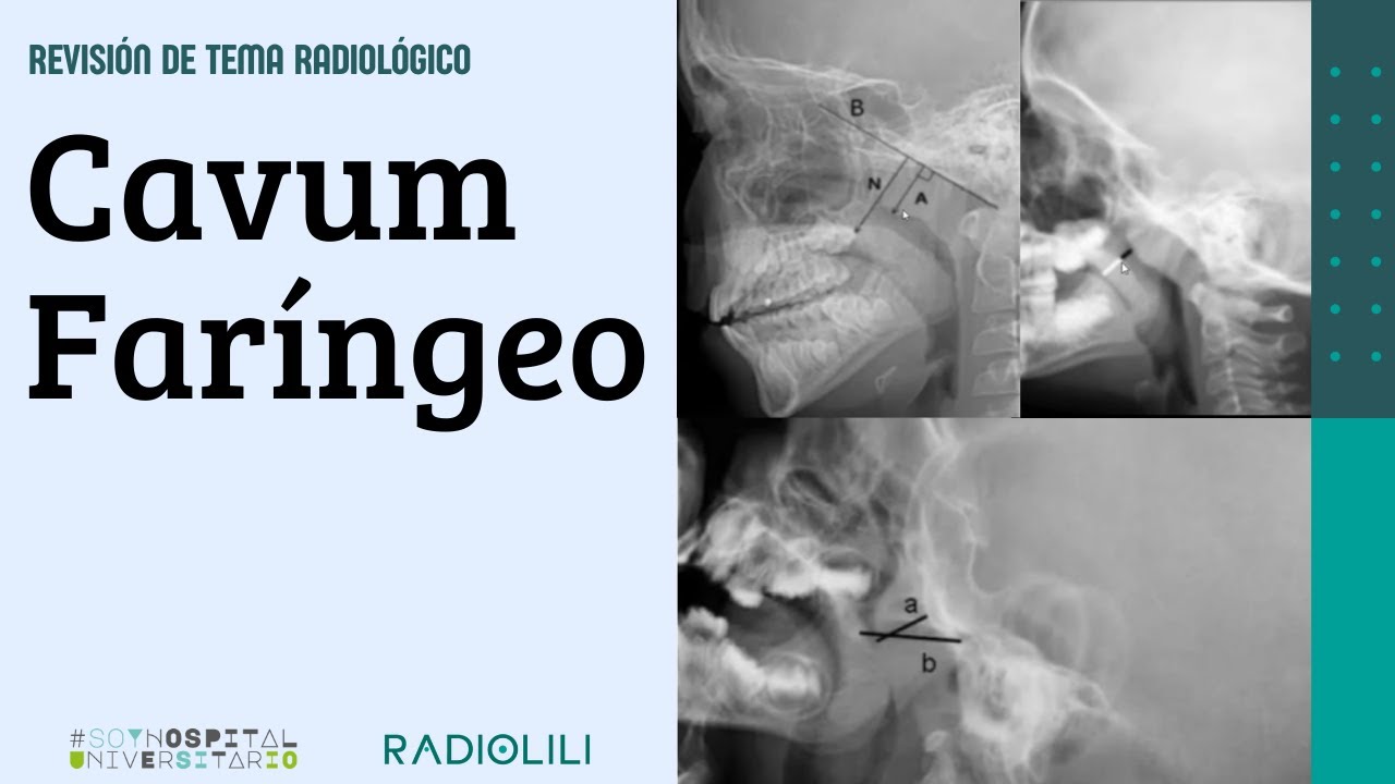 Cavum faríngeo