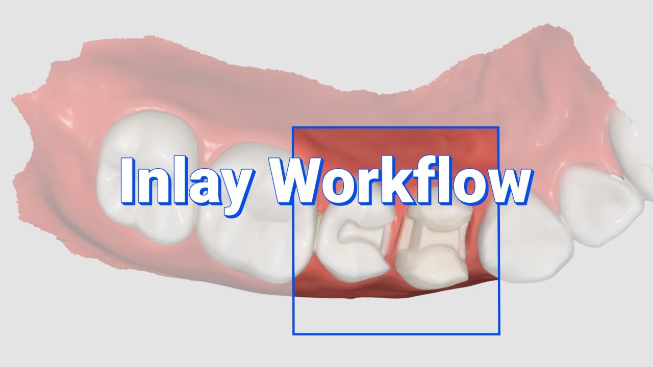 Inlay Workflow