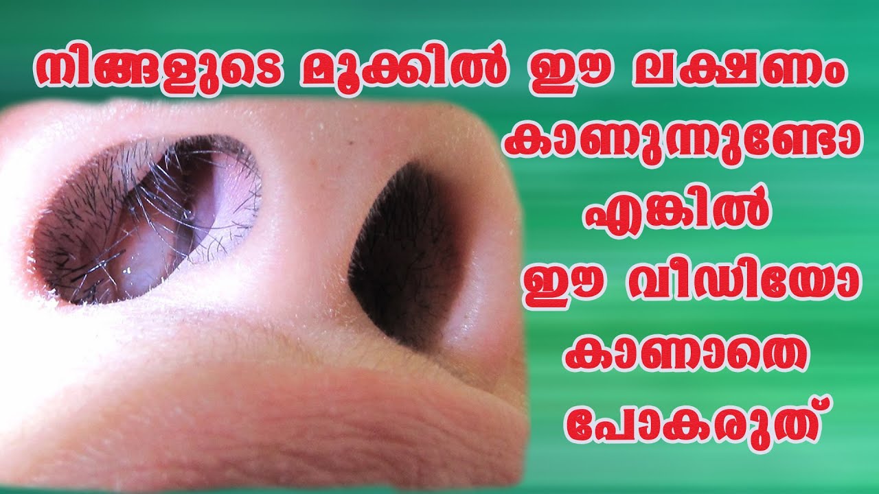 നിങ്ങളുടെ മൂക്കിൽ ഈ ലക്ഷണം കാണുന്നുണ്ടോ എങ്കിൽ ഈ വീഡിയോ കാണാതെ പോകരുത് /Baiju's Vlogs