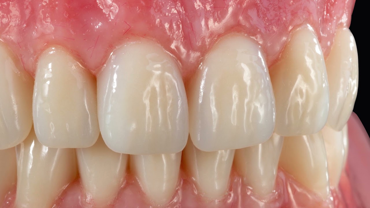 Delara denture teeth solution
