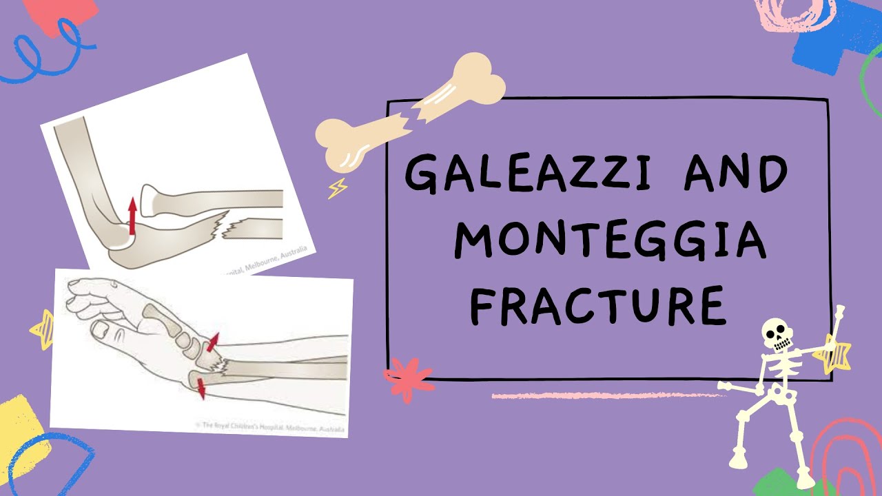 GALEAZZI AND MONTEGGIA FRACTURE