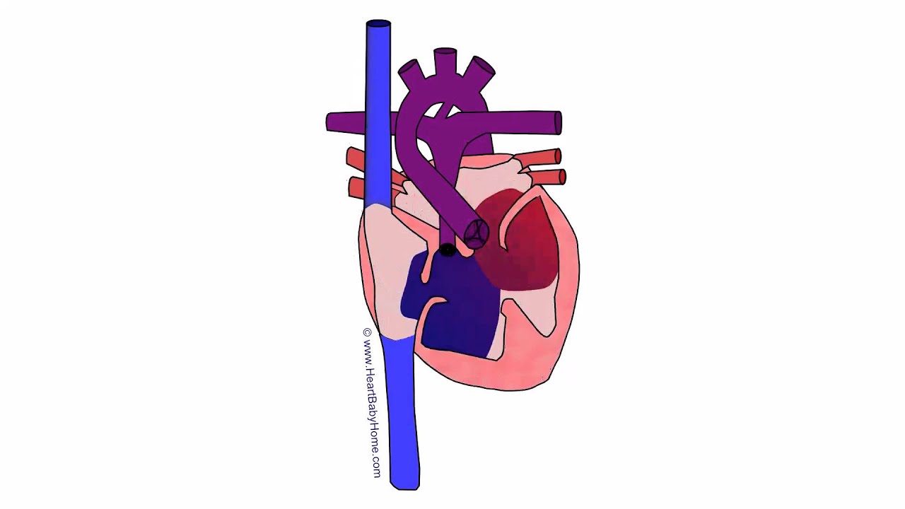 #78 Animated: Tetralogy of Fallot, CAVC, pulmonary atresia