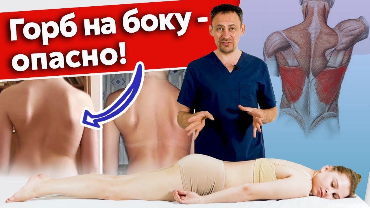 Асимметрия широчайшей мышцы спины / Мануальная терапия и тренировка для красивой осанки