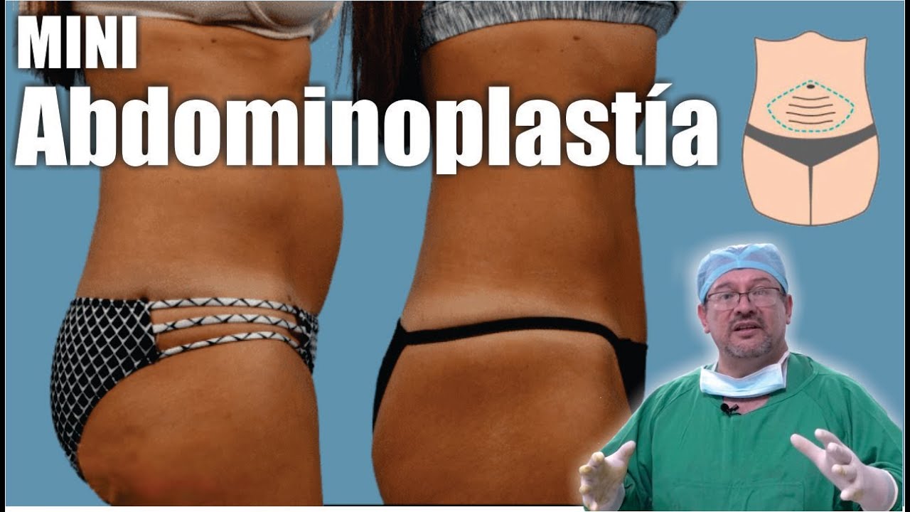 MINI ABDOMINOPLASTIA 👙 MINI TUMMY TUCK 👙 ¿Cuándo MINI y cuándo ABDOMINOPLASTÍA? ⭐ Dr. ALBERTO CALVO