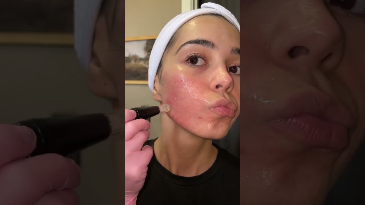 Microneedling Pen for Acne Scar Repair