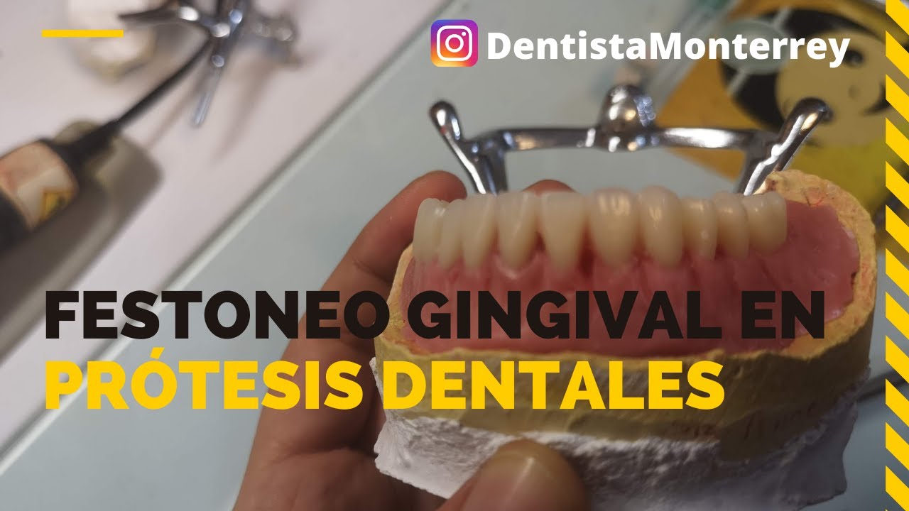 FESTONEO GINGIVAL 👅Prótesis Dental Inferior Parte3 #ProtesisDentales