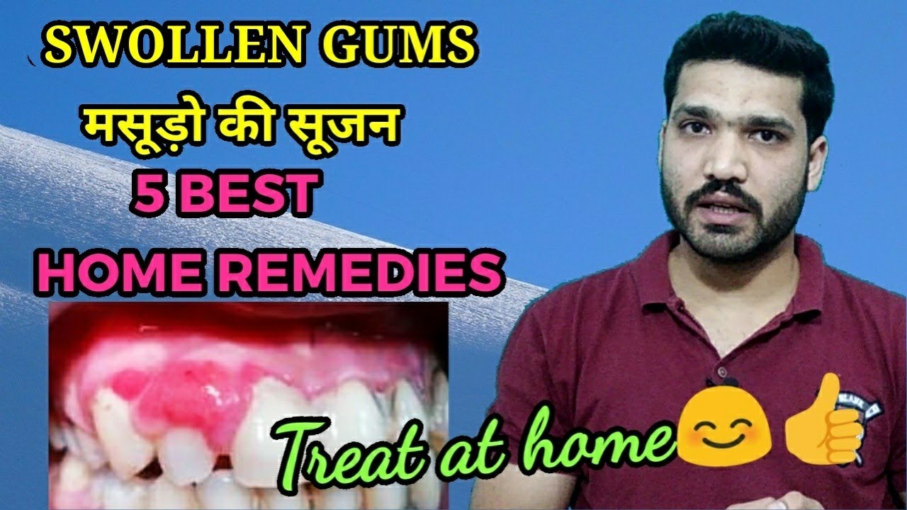 मसूड़ो की सूजन 5 घरेलू इलाज | 5 Best Home remedies for swollen gums
