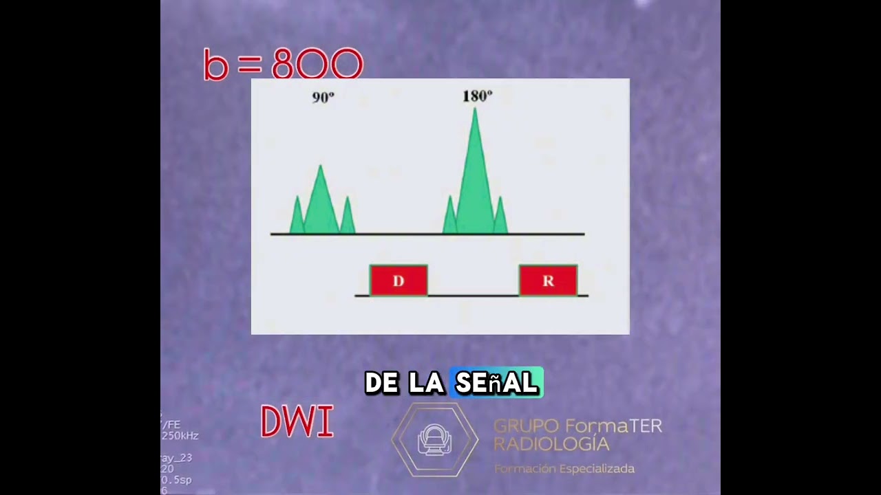 Secuencia DWI en RM 