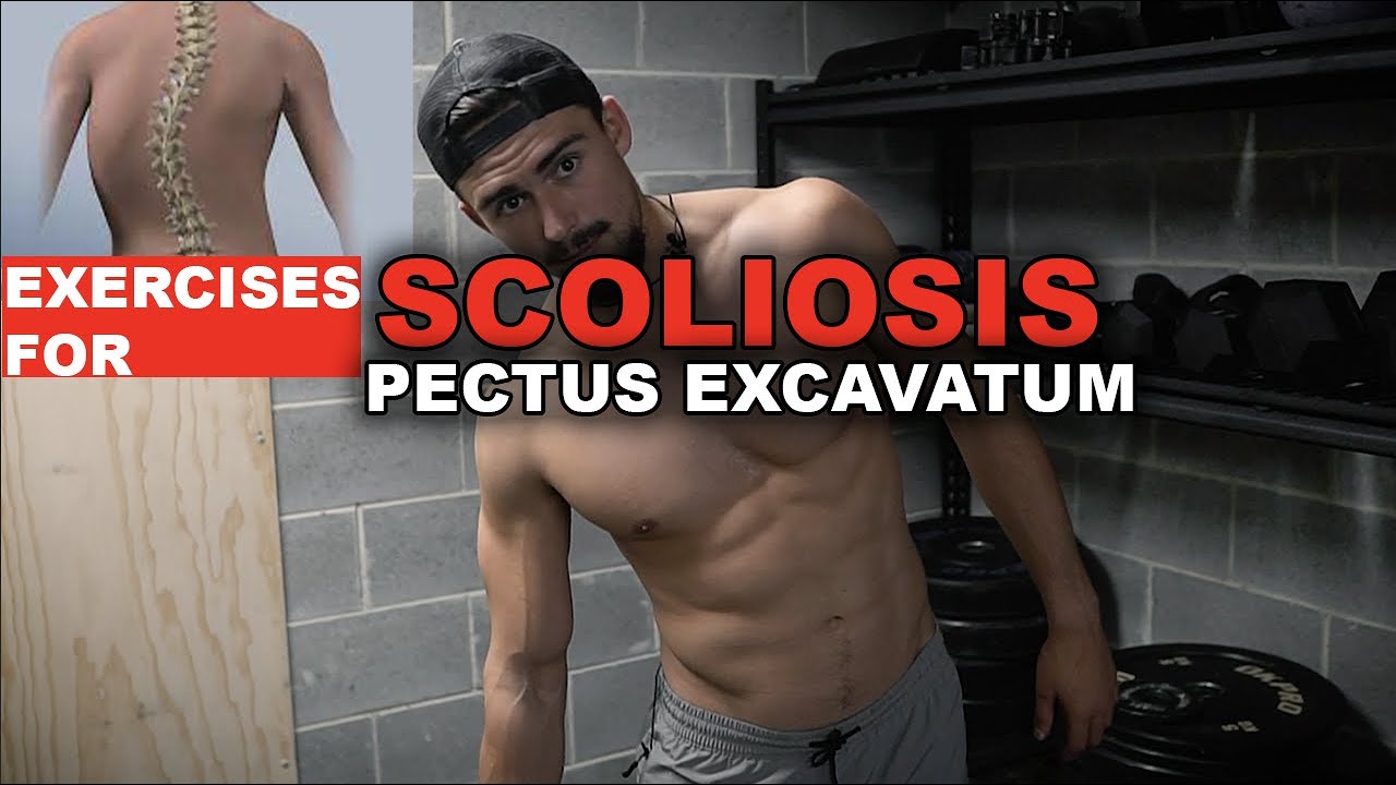 SCOLIOSIS & PECTUS EXCAVATUM (MY TIPS!)