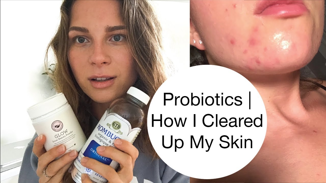 Probiotics  |  How I Cleared Up My Acne  |  Holistic Nutritionist Tips