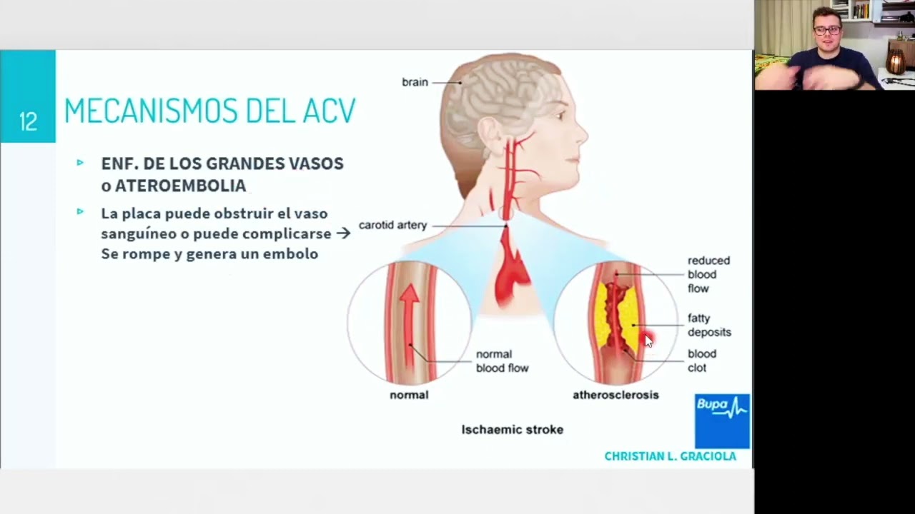 Neuro - ACV