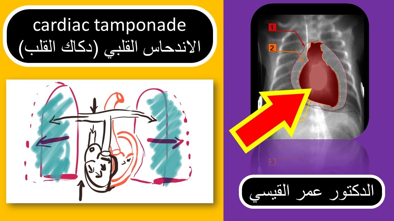 (الدكاك القلبي (انحسار القلب │cardiac tamponade اسبابه اعراضه وكيفية علاجه