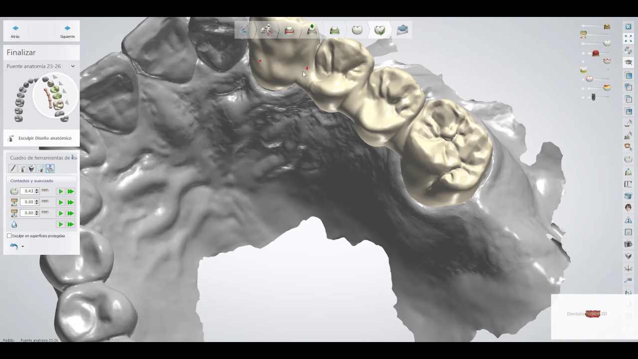 Prótesis Dental / 3shape / puente con redución vestibular