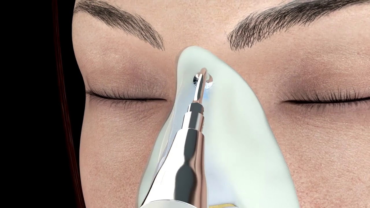 Rinoplastia ultrasónica: la técnica más precisa y menos invasiva | Cirugía de nariz