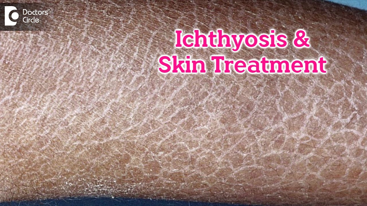 What is Ichthyosis? How to Treat my Skin?| Fish like scales On Skin-Dr.Rasya Dixit | Doctors' Circle