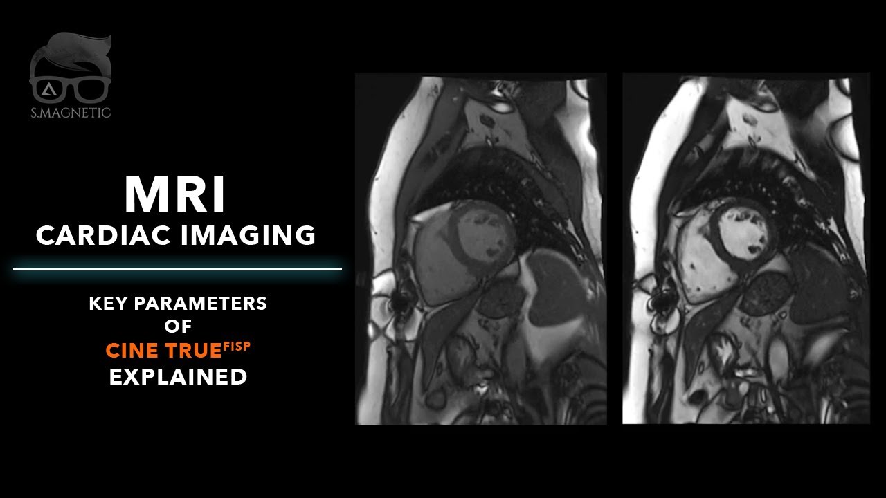 MRI – CARDIAC IMAGING : KEY PARAMETERS OF CINE TRUEFISP EXPLAINED