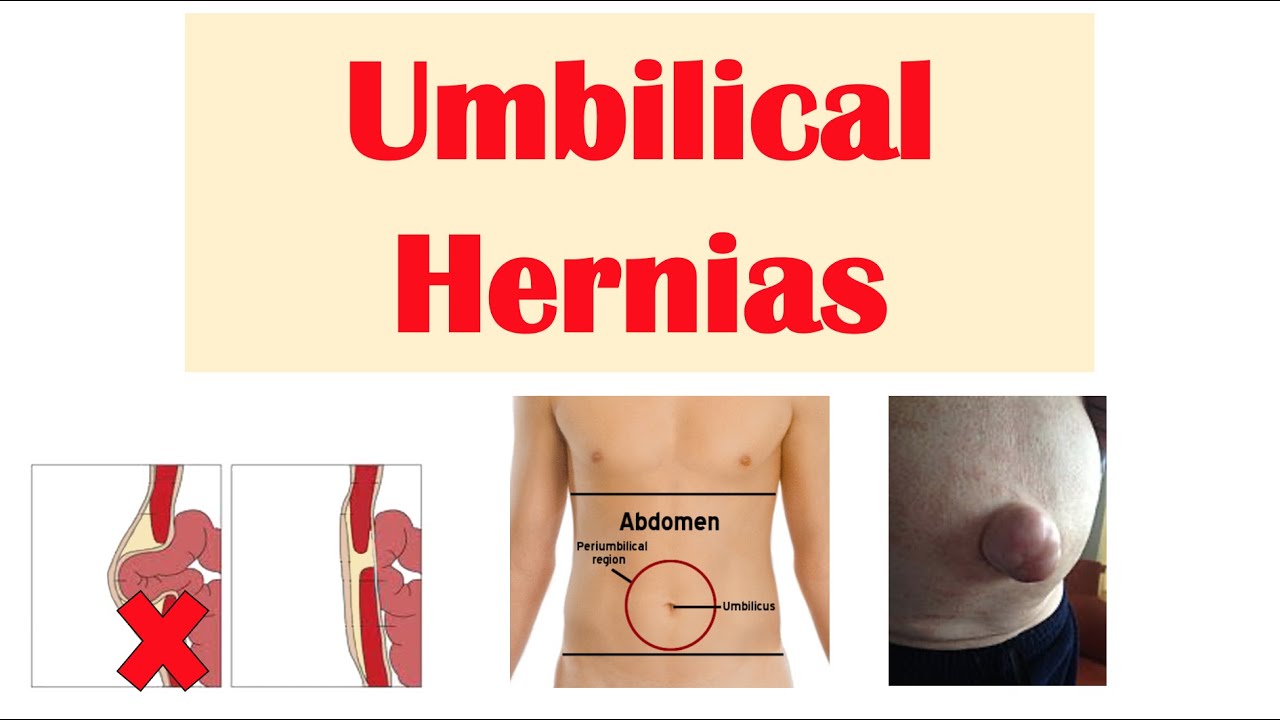 Umbilical Hernia | Belly Button Hernia | Risk Factors, Signs and Symptoms, Diagnosis, Treatment