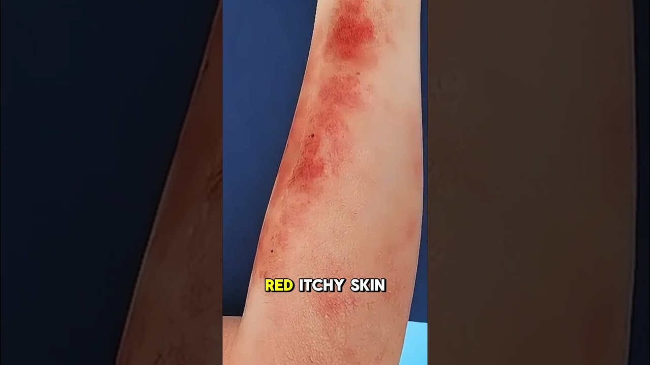 Chickenpox Explained | 3D Animated Medical Video (Short & Simple)