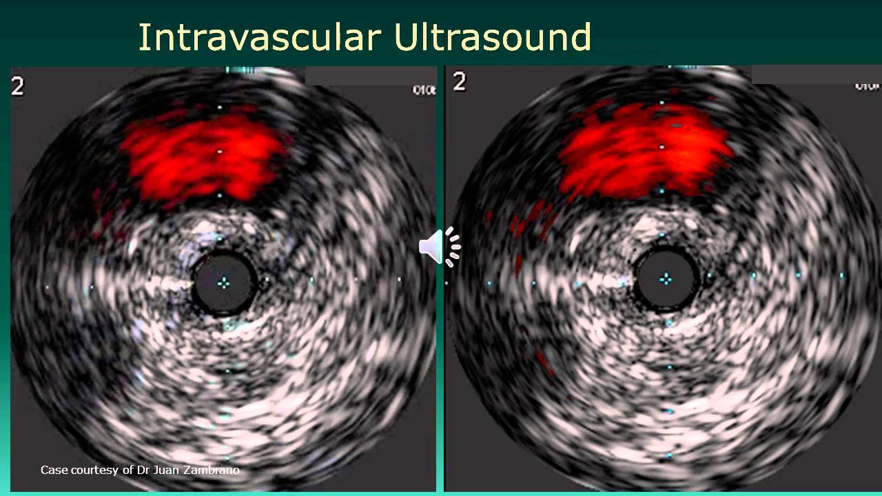 Versatility of Clinical Applications of the Pioneer Plus Catheter in CTO True Lumen Re-Entry