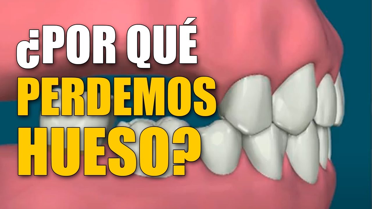 Odontolog&iacute;a Restauradora | Reabsorci&oacute;n del hueso tras perder un diente