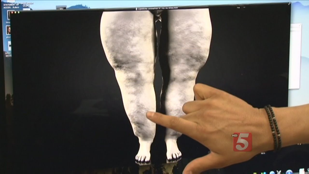New Procedure Helps Those Suffering From Lipedema