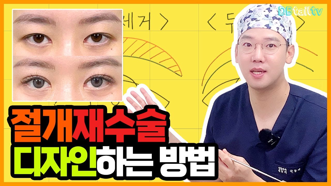 절개재수술 디자인하는 방법
