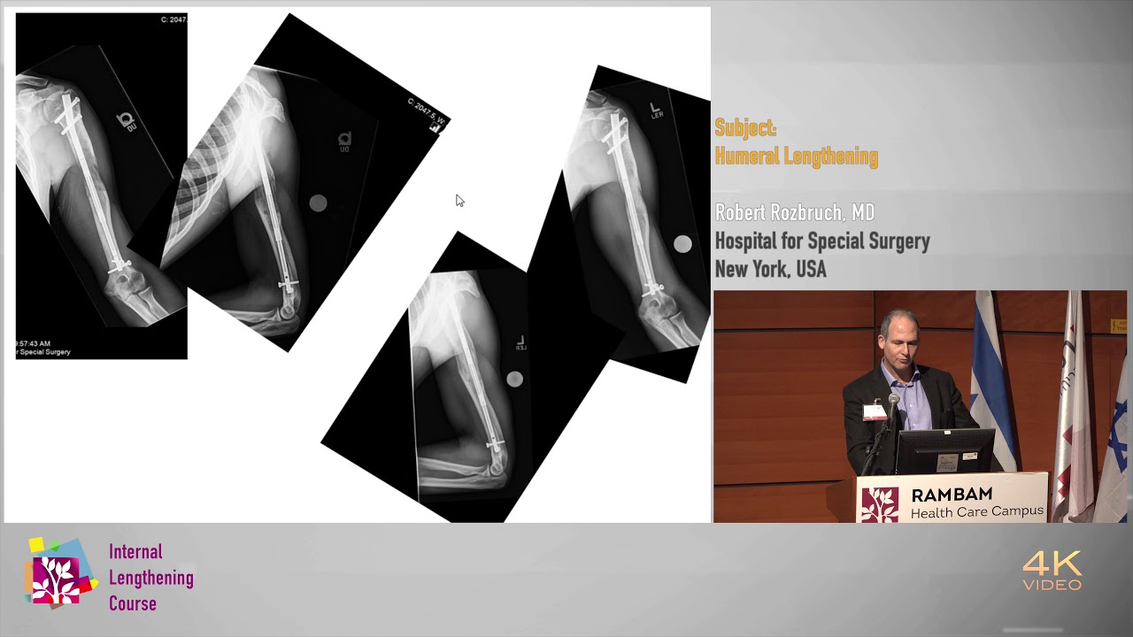18 Humeral Lengthening - Robert Rozbruch MD.