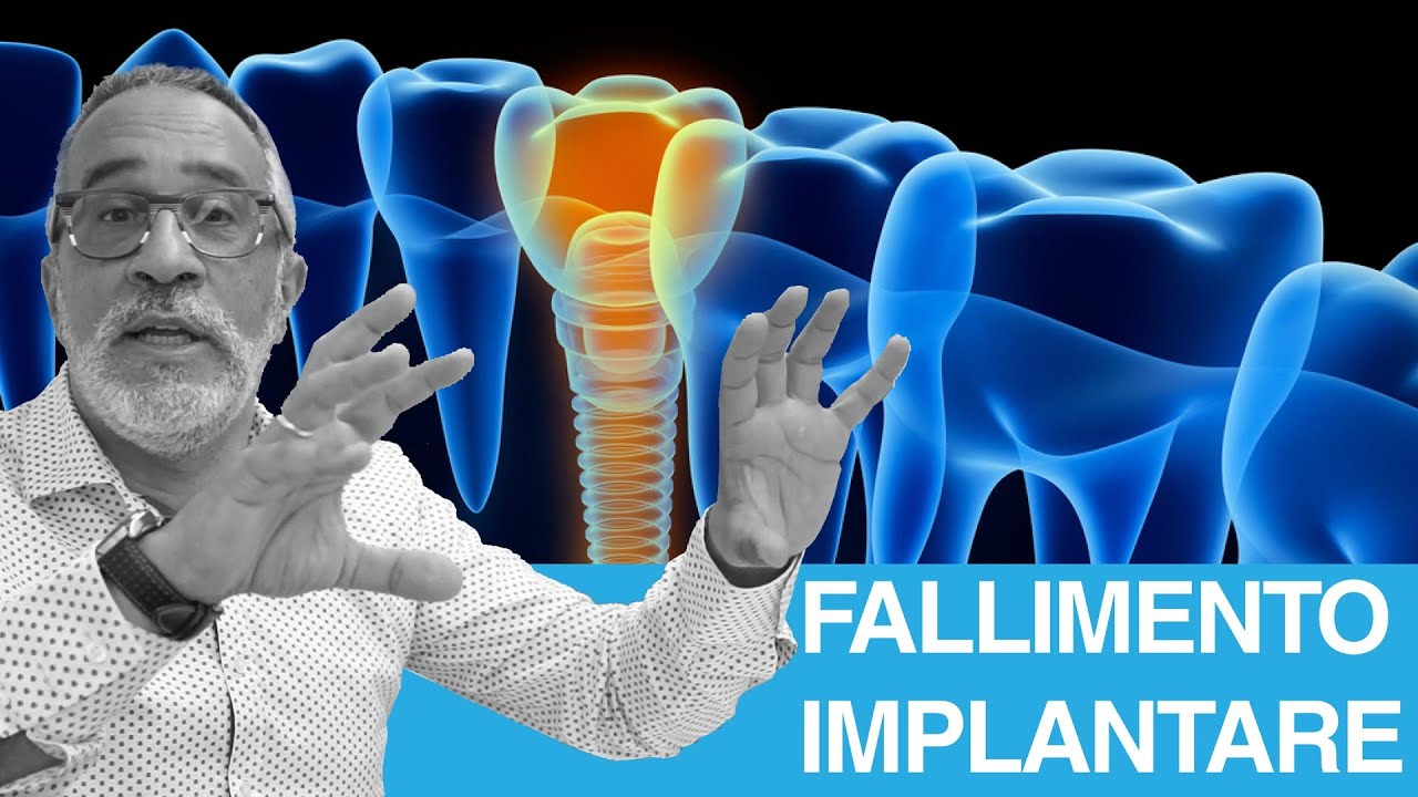 Fallimento dell'impianto dentale: da cosa dipende?
