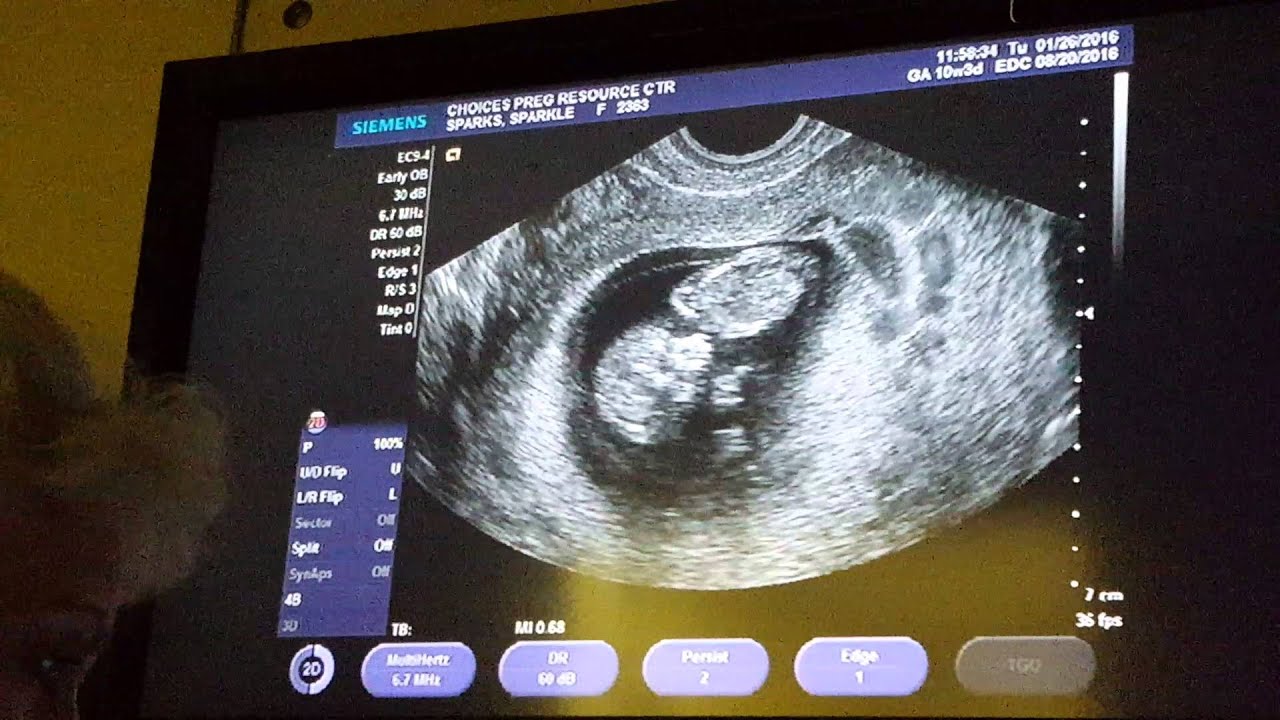 My Ultrasound at 10 Weeks Pregnant | Baby Hardnett👣2016
