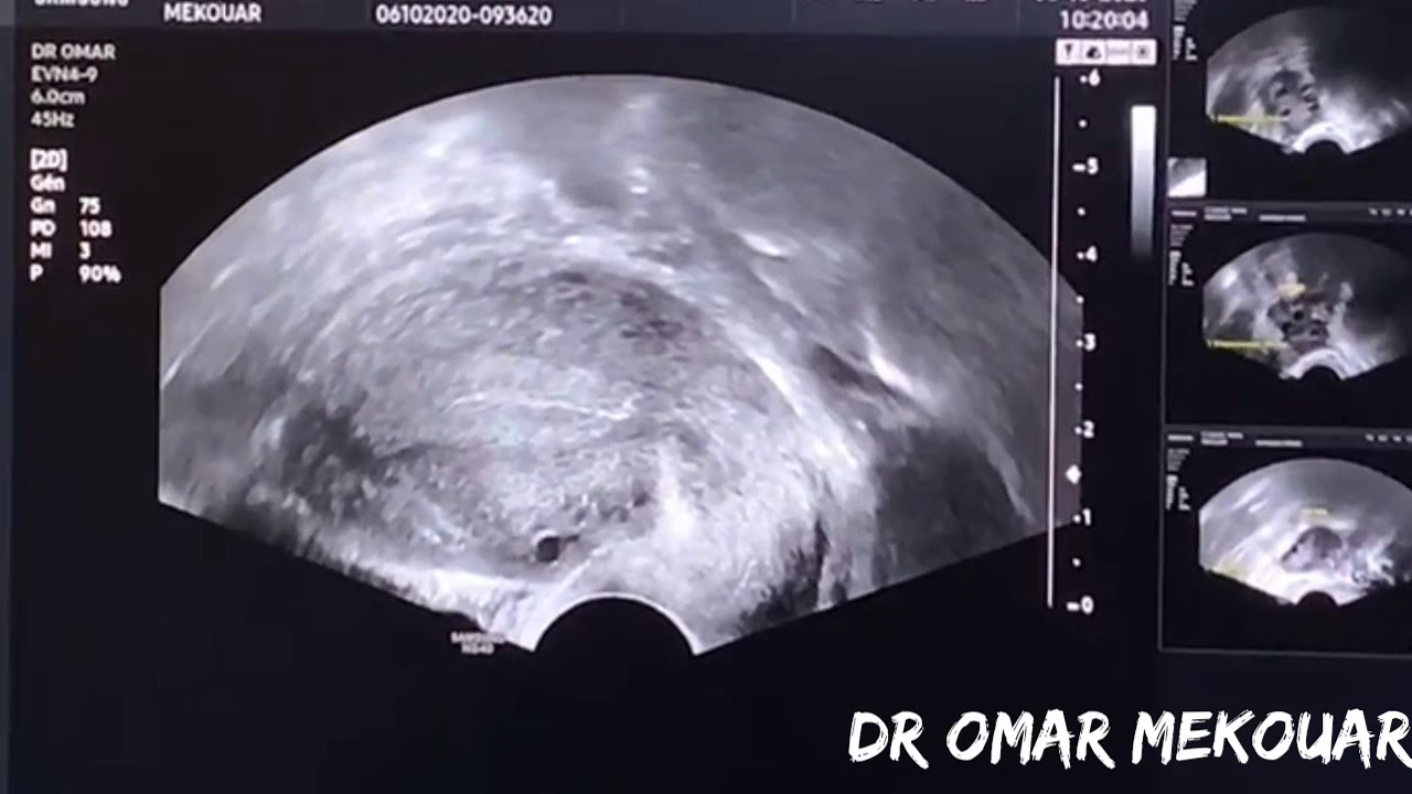 Check up de la FERTILITE  Fertiliscan