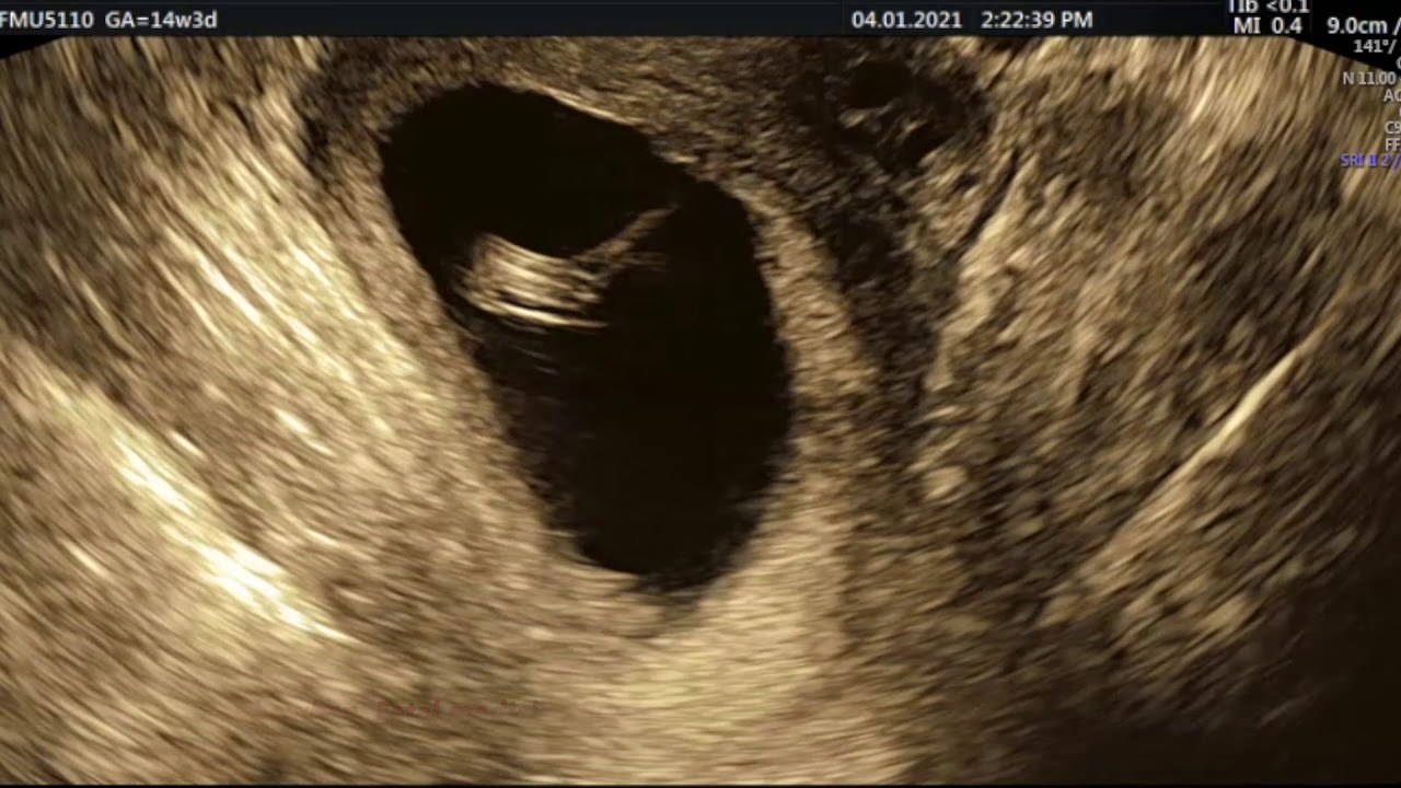 Arthrogryposis in first trimester by Dr S Chowhan