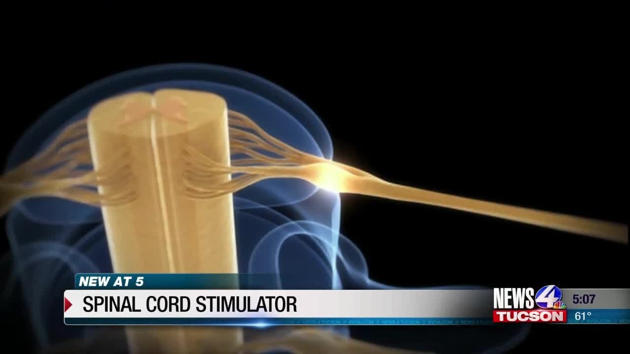 Neurosurgeon weighs in on spinal cord cord stimulators