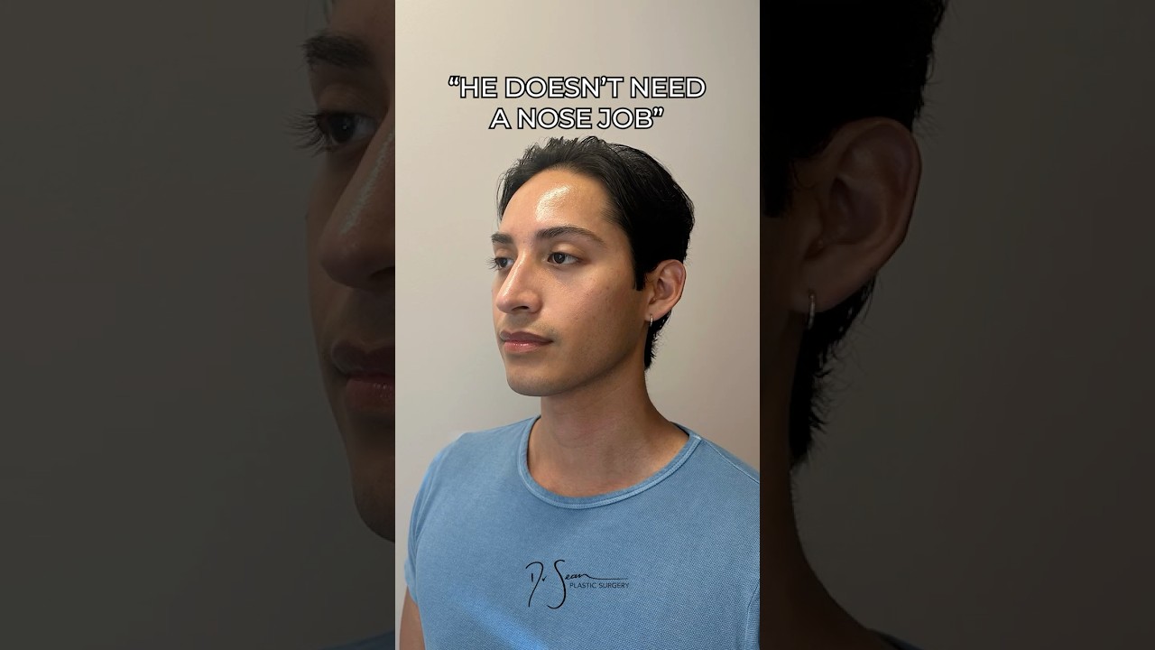 Male Rhinoplasty Before & After