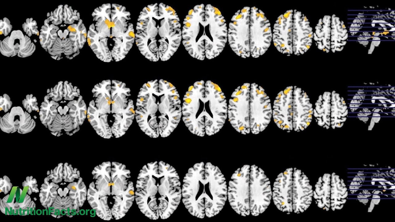 Preventing Parkinson's Disease With Diet