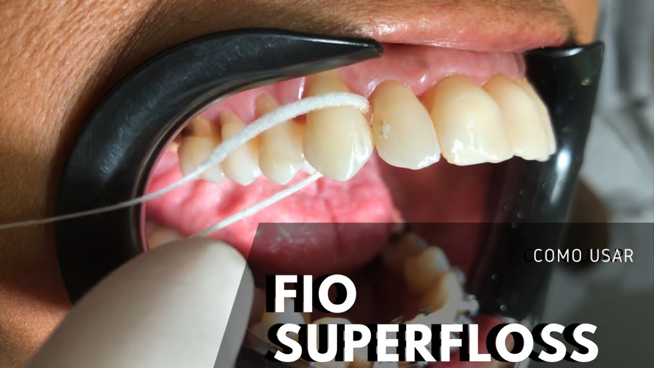 Como usar fio Superfloss da OralB | Dr. Victor Hugo Almeida