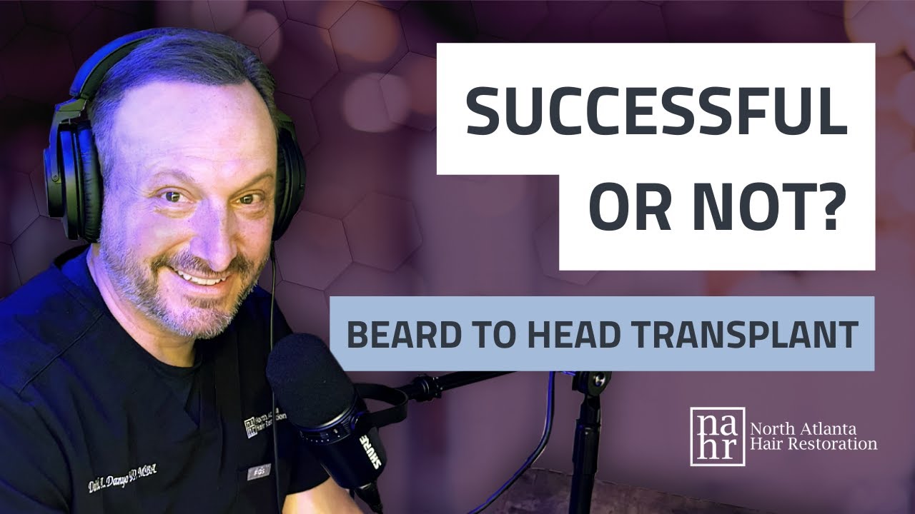 Are Beard to Head Transplants Successful?